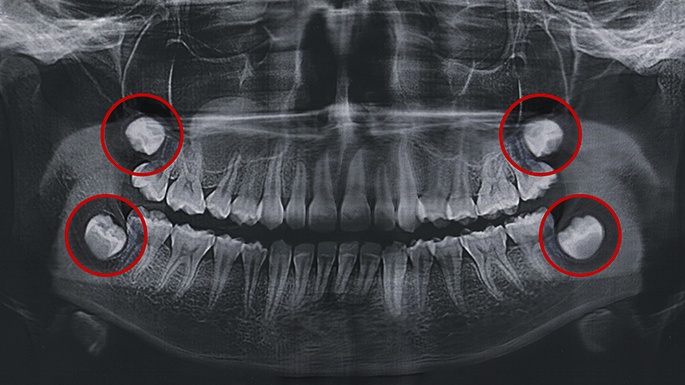 X-ray of smile with impacted wisdom teeth